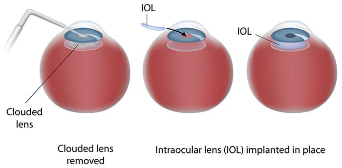 Chart Illustrating the cataract surgery process